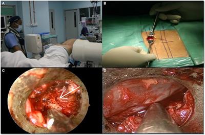 Feasibility of Unilateral Approach for Bilateral Decompressive Endoscopic Spinal Surgery for Lumbar Stenosis to Improve Back and Leg Pain: A Consecutive Single-Center Series of 60 Patients